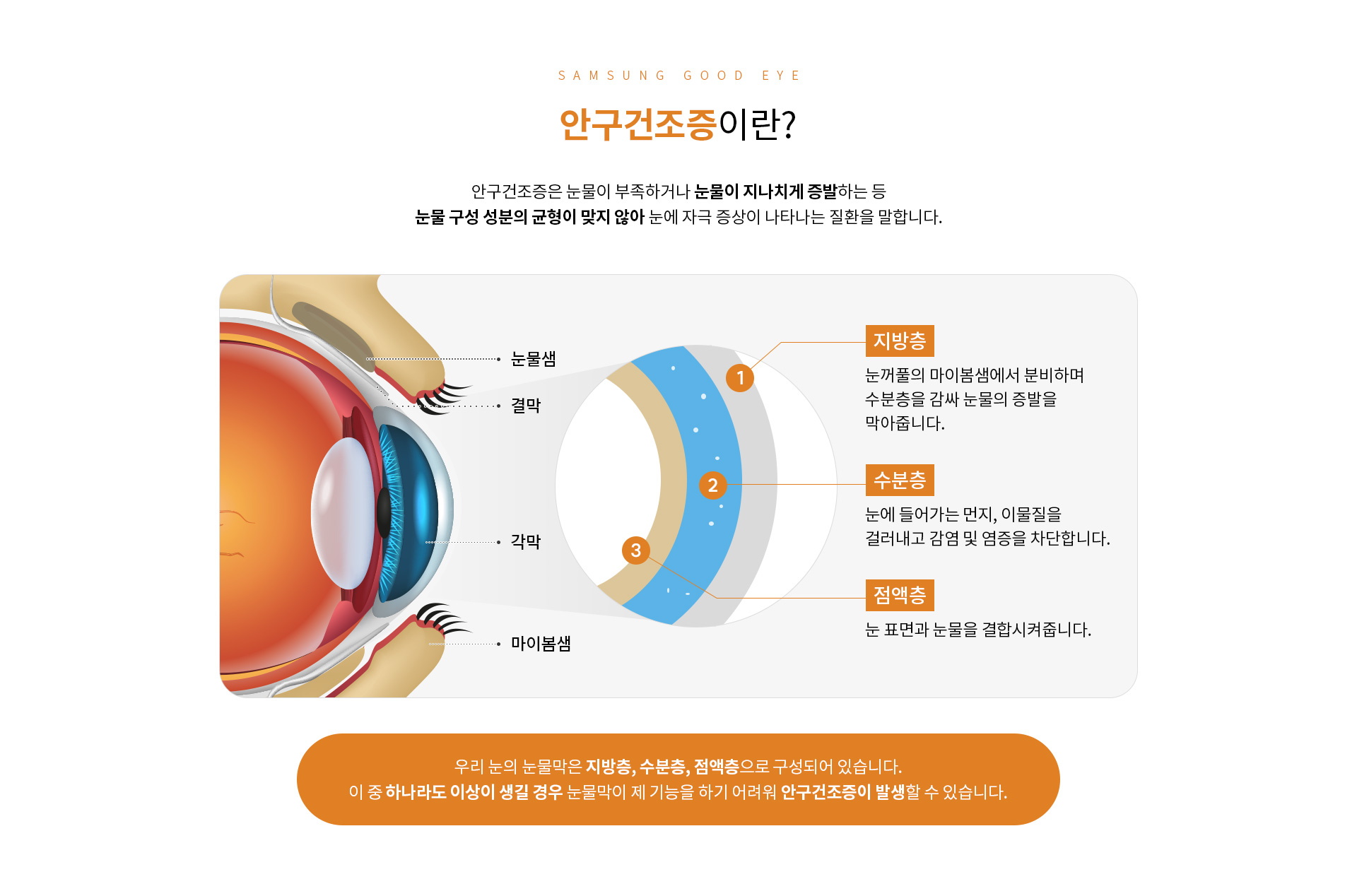 안구건조증_01