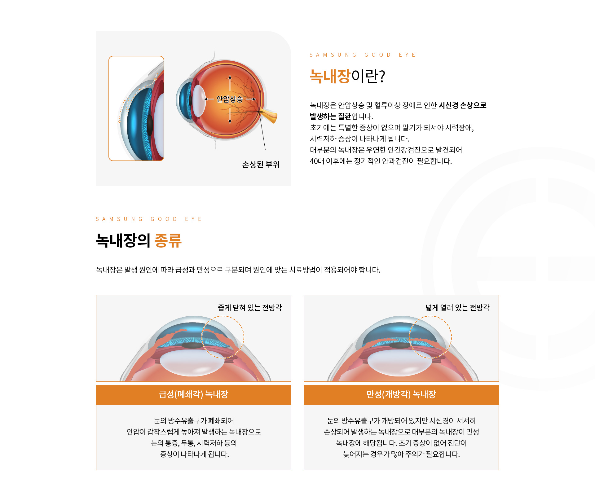 녹내장_01